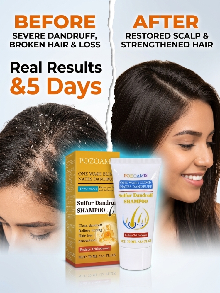 Hair Care Dandruff - Herbal Anti-Dandruff Shampoo, Help Relieve Scalp